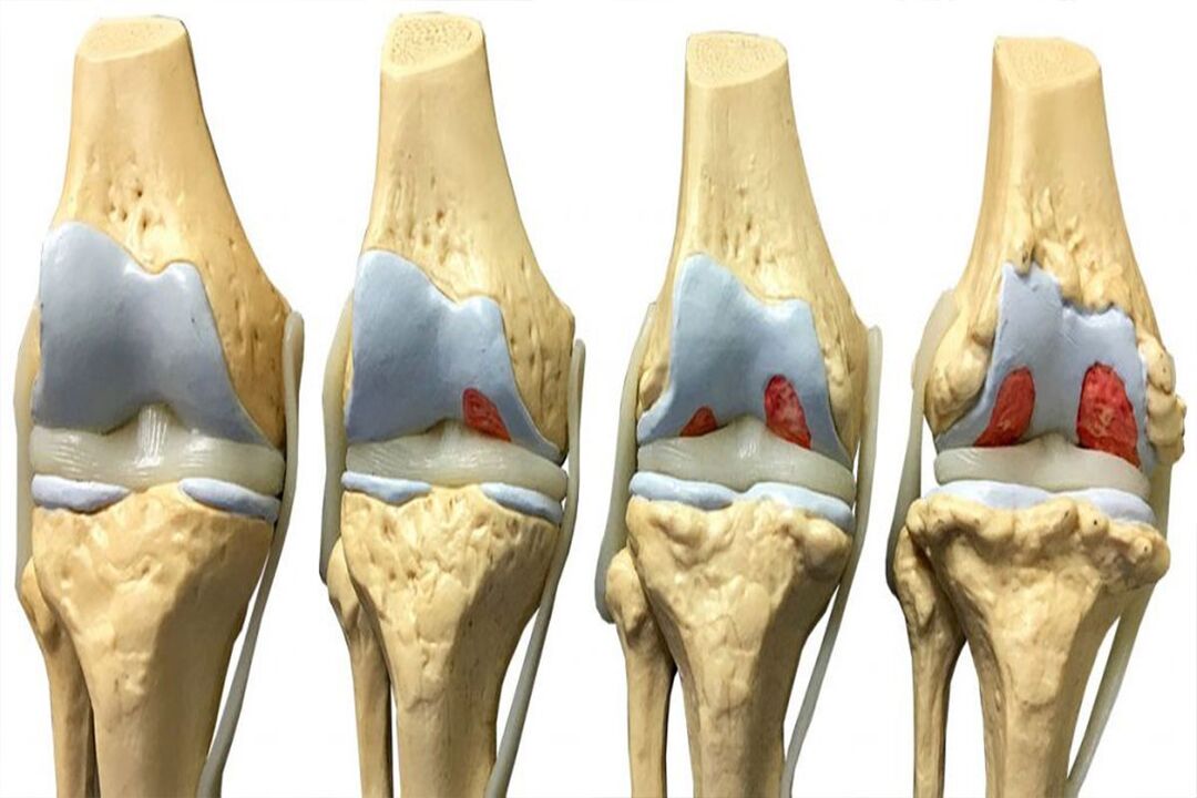 etapas de desarrollo de la osteoartritis