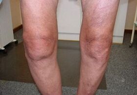 Cómo tratar la articulación de la rodilla artrosis