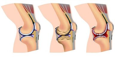 Articulación de la rodilla Etapas de desarrollo de artrosis