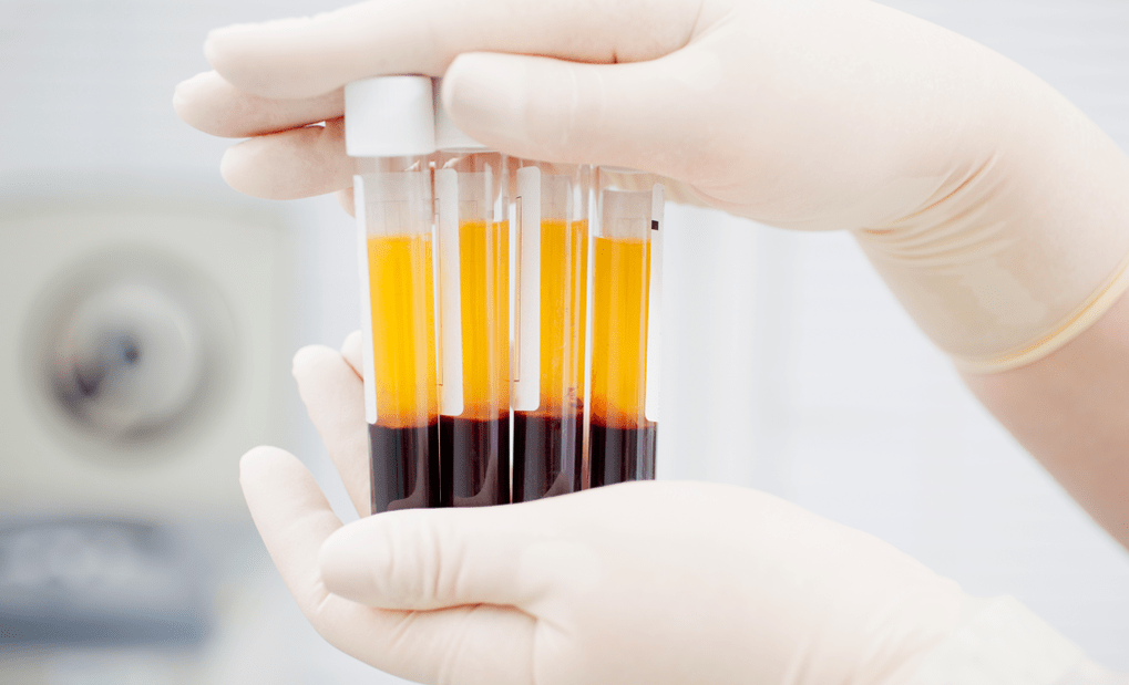 Plasma rico en plaquetas para la terapia con PRP para la osteoartritis