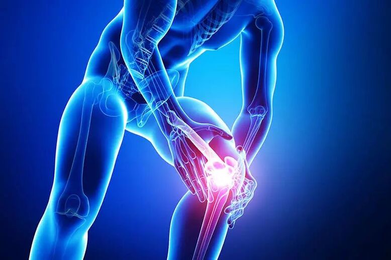 síntomas de osteoartritis