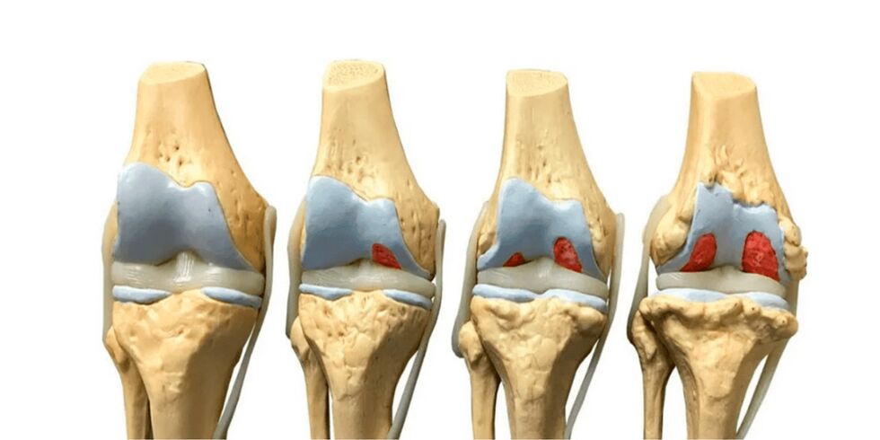 grado de artrosis articular